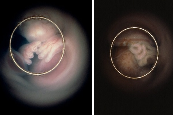 Fotografie del  bambino nella pancia della mamma endoscopio